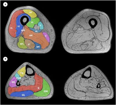 Longitudinal Quantitative MRI Evaluation of Muscle Involvement in Amyotrophic Lateral Sclerosis